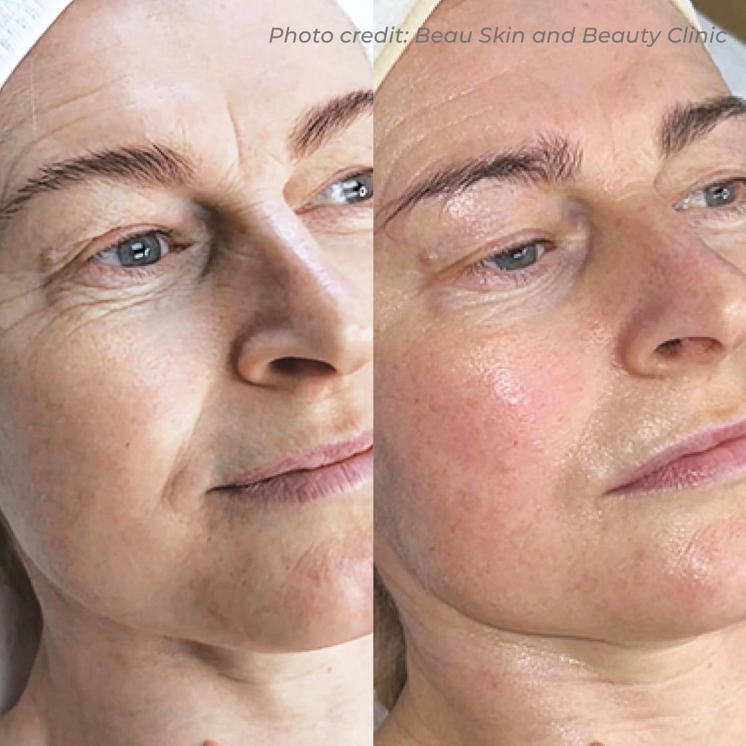 Anti-Ageing & Fine Line Reduction