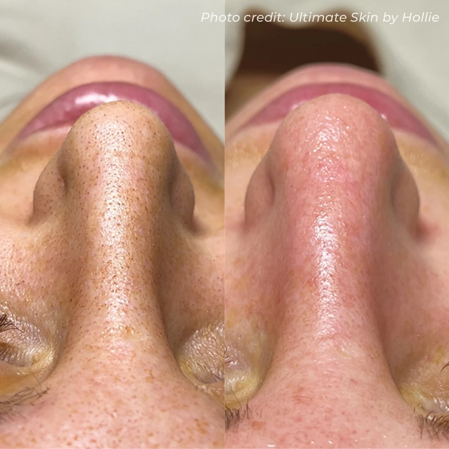 Complexion Clarification & Smoothness