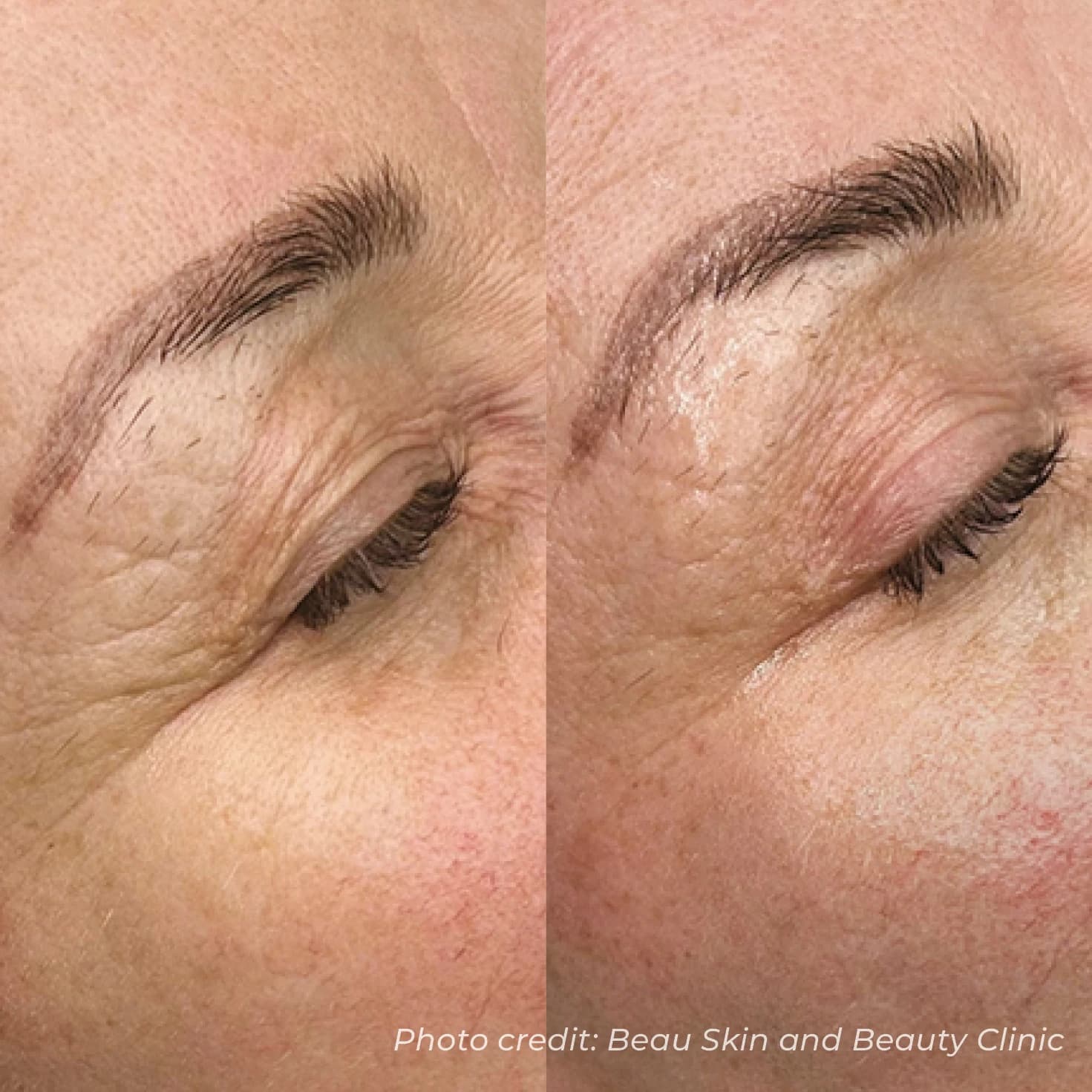Targeted Eye Area & Crow's Feet Smoothing