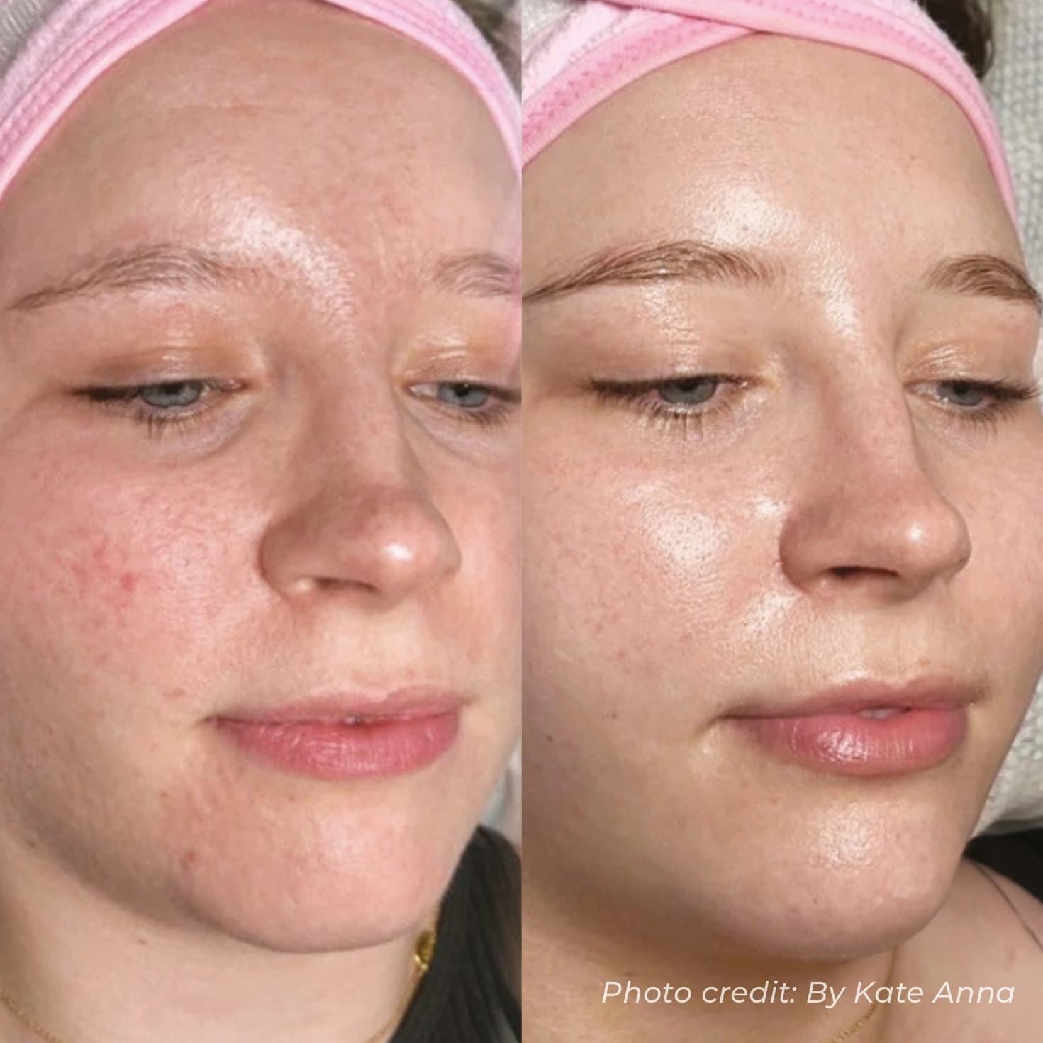 Deep Cleansing & Pore Minimisation