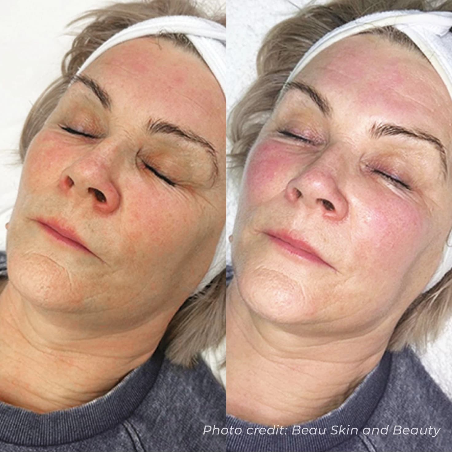Facial Rejuvenation & Radiance Restoration