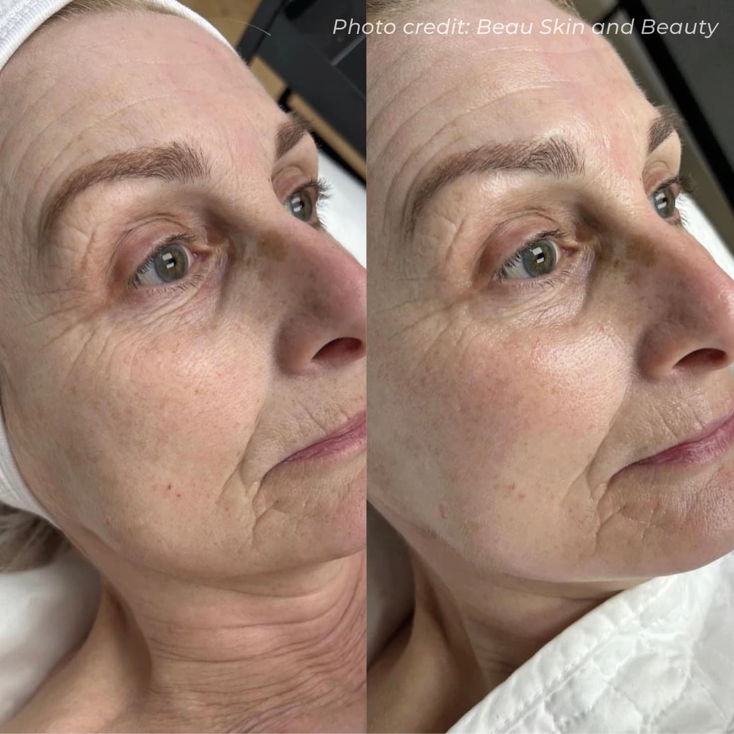 HydrO2facial Skin Clarification & Glow