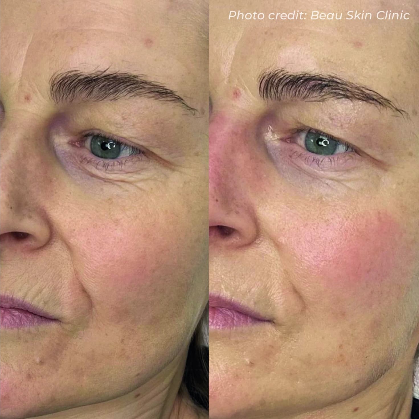 Single Session Instant Glow Transformation