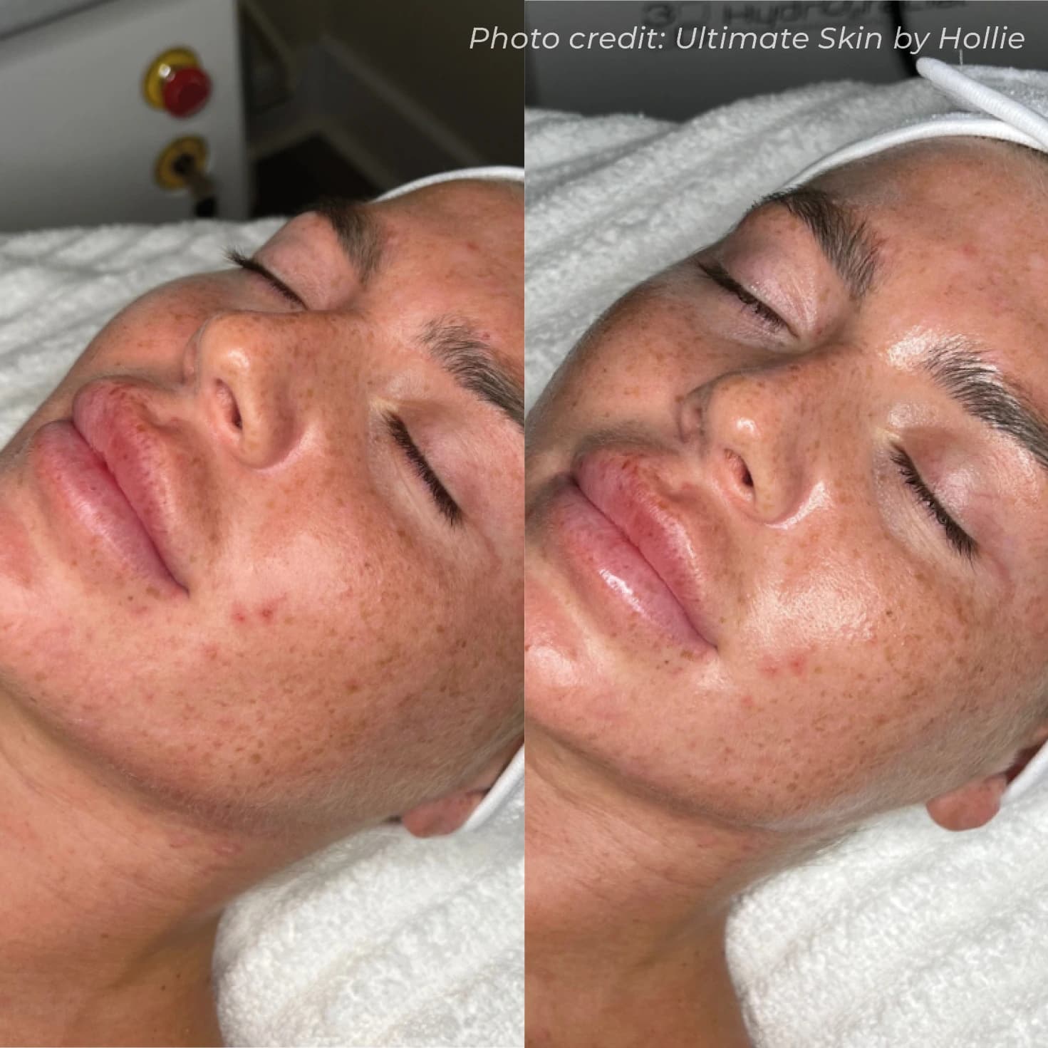 Skin Resurfacing & Tone Correction