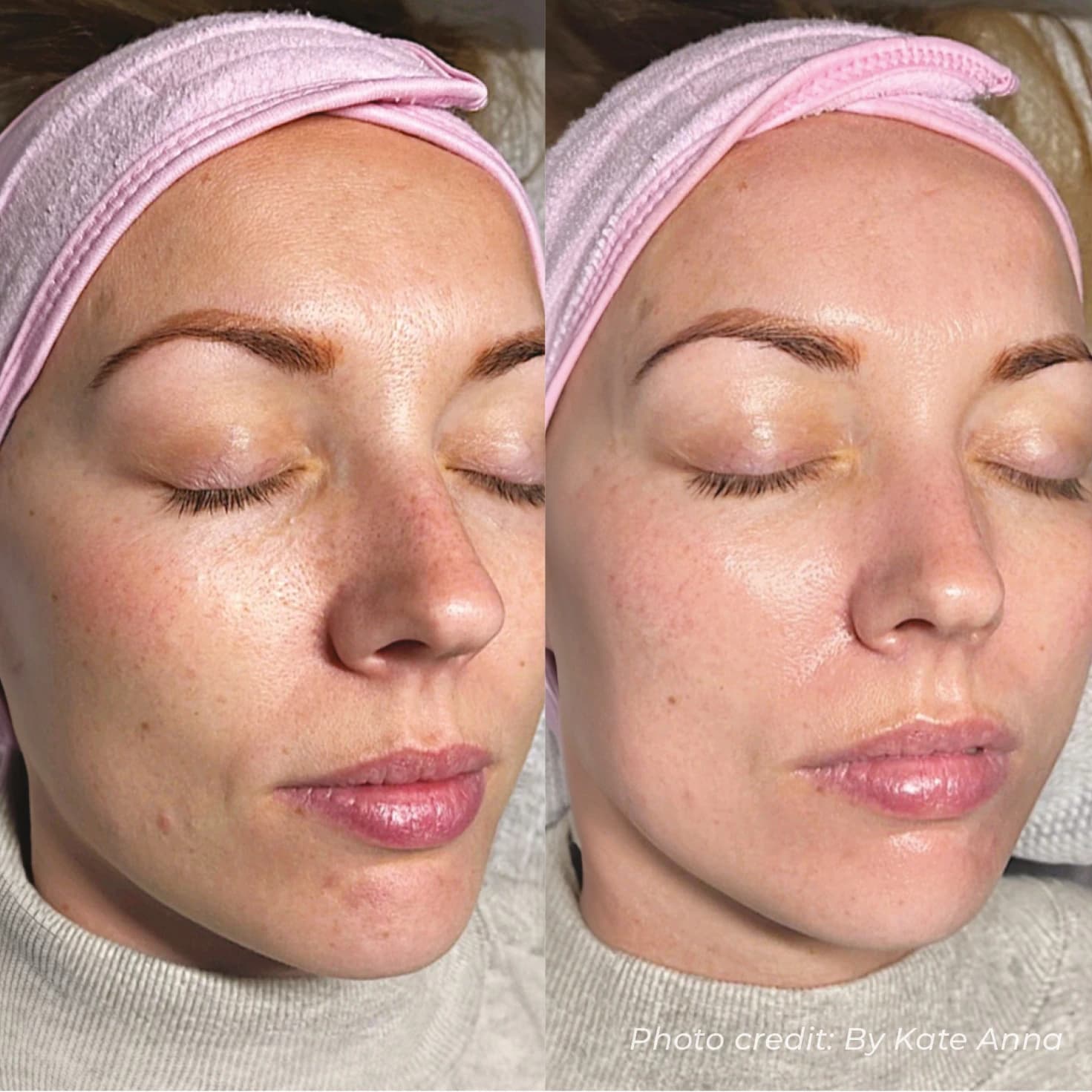 Skin Tightening & Texture Smoothing